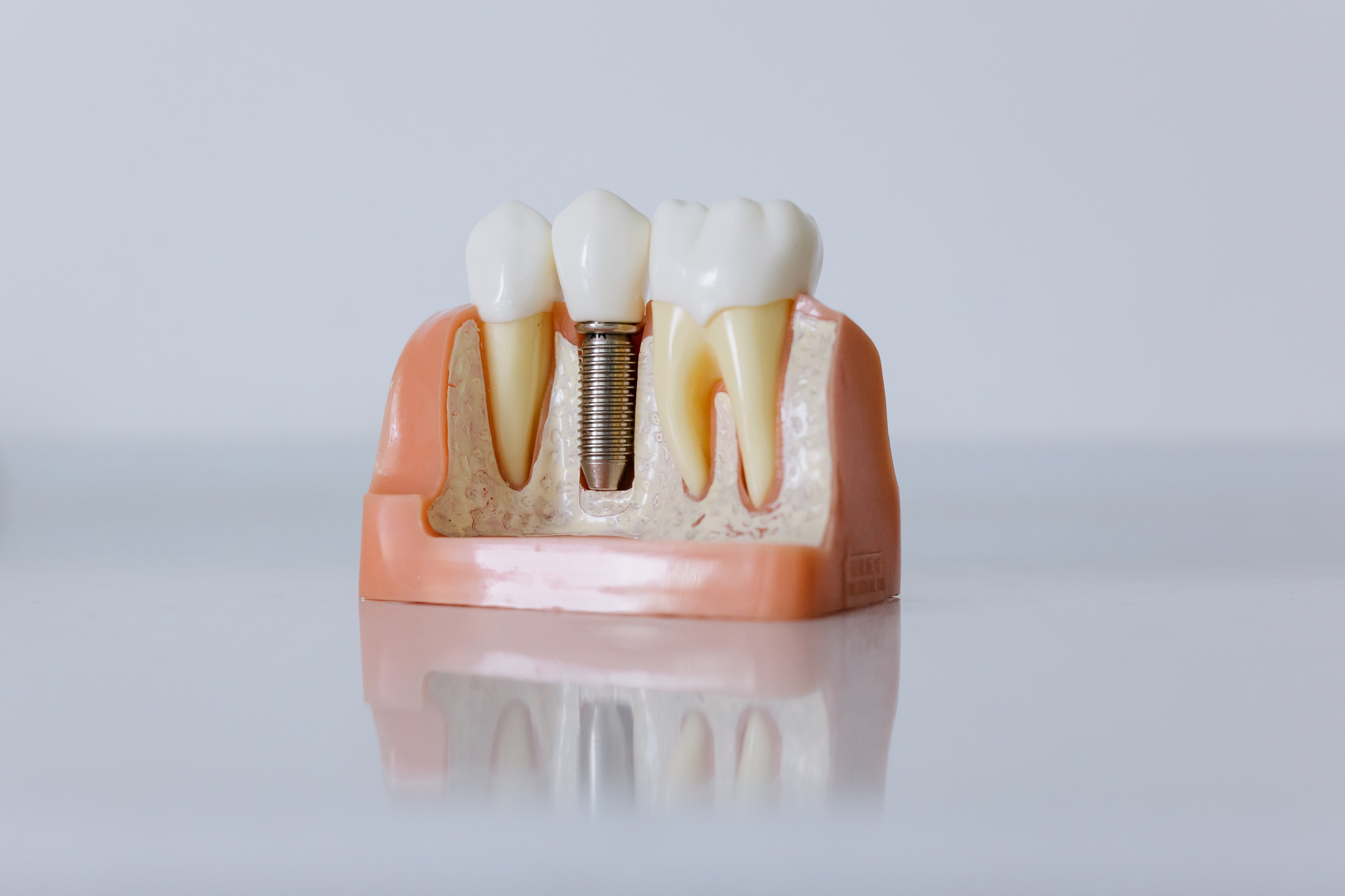 DentNatura Zahnimplantate