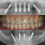 Zahnimpantate - Röntgenbild